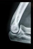 Elbow X-ray