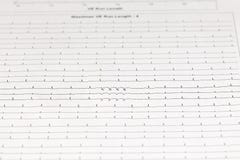 Arrhythmia Chart