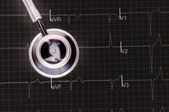 Estetoscopio en la opinión de top del gráfico del electrocardiograma ECG imágenes de archivo libres de regalías Estetoscopio en la opinión de top del gráfico del electrocardiograma ECG imágenes de archivo libres de regalías