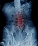 Estímulo lumbar y escoliosis fotografía de archivo Estímulo lumbar y escoliosis fotografía de archivo