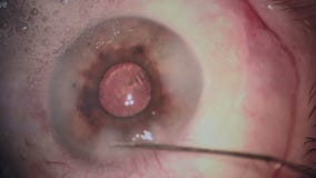 Eye surgery. Cataract removal surgery. Close up.