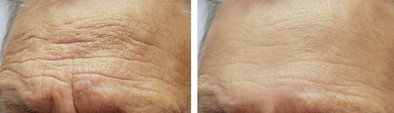 Face elderly man forehead wrinkles face before and after procedures
