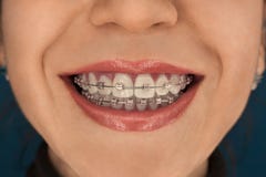 Face of the girl smiling with braces on her teeth against royalty free stock image Face of the girl smiling with braces on her teeth against royalty free stock image