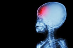 Film x-ray body of child and headache ( brain disease ) ( isolated ) stock photos Film x-ray body of child and headache ( brain disease ) ( isolated ) stock photos