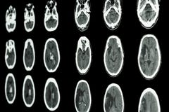 FilmCT-bildläsning av den ischemic slaglängden för hjärnshow och hemorrhagic strok royaltyfri bild FilmCT-bildläsning av den ischemic slaglängden för hjärnshow och hemorrhagic strok royaltyfri bild