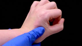 Fine del morso di insetto su Medico in guanto medico blu ispeziona il sito del morso archivi video Fine del morso di insetto su Medico in guanto medico blu ispeziona il sito del morso archivi video