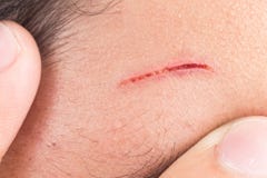 Fingers embrace painful wound on forehead from deep cut stock photography Fingers embrace painful wound on forehead from deep cut stock photography