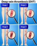 Four Stages of Deep Vein Thrombosis stock illustration Four Stages of Deep Vein Thrombosis stock illustration