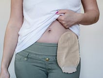 Främre sikt på colostomypåse i hudfärg som fästas till kvinnapatienten Närbild på ostomy påse efter kirurgi arkivfoton Främre sikt på colostomypåse i hudfärg som fästas till kvinnapatienten Närbild på ostomy påse efter kirurgi arkivfoton
