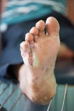 Fußgeschwüre vom Diabetes stockfoto Fußgeschwüre vom Diabetes stockfoto