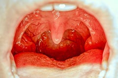 Gardła tonsil obraz royalty free Gardła tonsil obraz royalty free