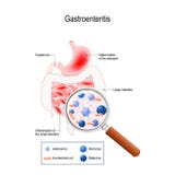 gastroenterite illustrazione vettoriale gastroenterite illustrazione vettoriale