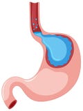 Gastroesophageal Reflux στάδιο ασθενειών ελεύθερη απεικόνιση δικαιώματος Gastroesophageal Reflux στάδιο ασθενειών ελεύθερη απεικόνιση δικαιώματος