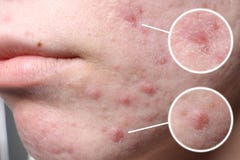 Giovane donna con il problema dell'acne prima di chirurgia estetica, primo piano immagine stock Giovane donna con il problema dell'acne prima di chirurgia estetica, primo piano immagine stock