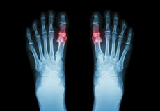 Gout, Rheumatoid αρθρίτιδα (πόδι ακτίνας X ταινιών και και metatarsophalangeal ένωση αρθρίτιδας καταρχάς) (ιατρική και επιστήμη b στοκ φωτογραφία με δικαίωμα ελεύθερης χρήσης Gout, Rheumatoid αρθρίτιδα (πόδι ακτίνας X ταινιών και και metatarsophalangeal ένωση αρθρίτιδας καταρχάς) (ιατρική και επιστήμη b στοκ φωτογραφία με δικαίωμα ελεύθερης χρήσης