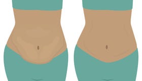 Gros et minces ventres de ` de filles Avant et après illustration stock Gros et minces ventres de ` de filles Avant et après illustration stock