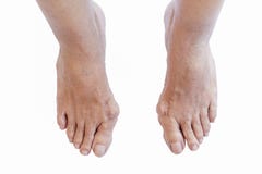 Hallux valgus, bunion in foot on white background stock photos Hallux valgus, bunion in foot on white background stock photos
