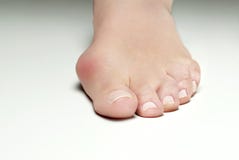 Hallux valgus, bunion in woman foot on white background stock photography Hallux valgus, bunion in woman foot on white background stock photography