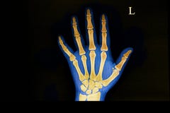 traumatic fracture of the hand bone stock photography traumatic fracture of the hand bone stock photography