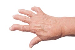 Hand With Rheumatoid Arthritis Stock Image Hand With Rheumatoid Arthritis Stock Image