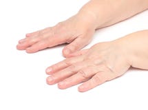 The hands of an elderly woman on a white background which has skin problems, irritation and redness on the skin, hypoallergenic royalty free stock image The hands of an elderly woman on a white background which has skin problems, irritation and redness on the skin, hypoallergenic royalty free stock image
