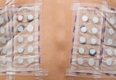 Haut-Allergie-Prüfung lizenzfreies stockfoto Haut-Allergie-Prüfung lizenzfreies stockfoto