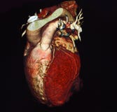 Heart Computed Tomography