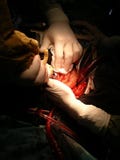 Heart laser surgery