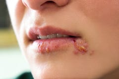 Herpes blisters stock image Herpes blisters stock image