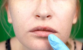 Herpes na wargach, część kobiety ` s twarz z palcem na wargach z herpes, piękna pojęcie obraz stock Herpes na wargach, część kobiety ` s twarz z palcem na wargach z herpes, piękna pojęcie obraz stock