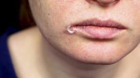 Herpes sulle labbra: una donna con un freddo ed il virus di herpes è esaminata da uno specialista della malattia infettiva e del video d archivio Herpes sulle labbra: una donna con un freddo ed il virus di herpes è esaminata da uno specialista della malattia infettiva e del video d archivio