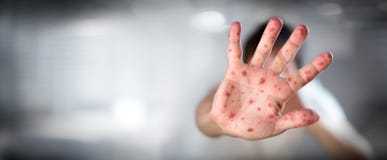 HFMD - Hand foot and mouth disease - Viral Diseases