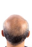 Hombre calvo de la pérdida de pelo foto de archivo libre de regalías Hombre calvo de la pérdida de pelo foto de archivo libre de regalías