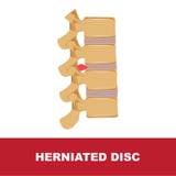 Herniated disc illustration royalty free illustration Herniated disc illustration royalty free illustration
