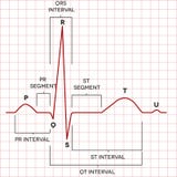 Sinus Rhythm Chart