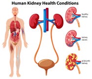 Human Kidney Health Conditions stock illustration Human Kidney Health Conditions stock illustration