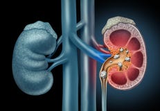 Human kidney Stones Medical Concept