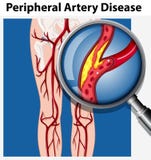 Human with Peripheral Artery Disease vector illustration Human with Peripheral Artery Disease vector illustration