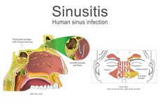 Human Sinusitis, Inflammation. Illustration, Vector art. stock illustration Human Sinusitis, Inflammation. Illustration, Vector art. stock illustration