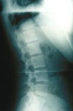 Human Spine Xray
