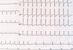 Ideia superior de um eletrocardiograma no formulário de papel impresso para cuidados médicos e conceito ou fundo médico ECG ou EC imagens de stock royalty free Ideia superior de um eletrocardiograma no formulário de papel impresso para cuidados médicos e conceito ou fundo médico ECG ou EC imagens de stock royalty free