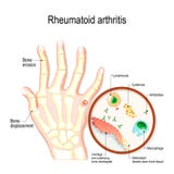 Il RA di artrite reumatoide è una malattia immune automatica e un tipo infiammatorio di artrite royalty illustrazione gratis Il RA di artrite reumatoide è una malattia immune automatica e un tipo infiammatorio di artrite royalty illustrazione gratis