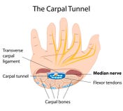 Il traforo del carpal illustrazione vettoriale Il traforo del carpal illustrazione vettoriale