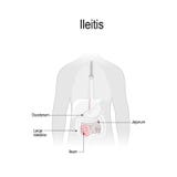 Ileitis jest rozognieniem Część mały jelito royalty ilustracja Ileitis jest rozognieniem Część mały jelito royalty ilustracja