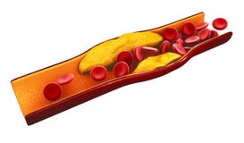 Illustration of blood cells with plaque buildup of cholesterol isolated white vector illustration Illustration of blood cells with plaque buildup of cholesterol isolated white vector illustration