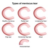 Illustrazione medica di vettore di lesioni del menisco isolata su fondo bianco, strappo del menisco royalty illustrazione gratis Illustrazione medica di vettore di lesioni del menisco isolata su fondo bianco, strappo del menisco royalty illustrazione gratis