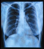 Image de radiographie de la poitrine Photo libre de droits Image de radiographie de la poitrine Photo libre de droits