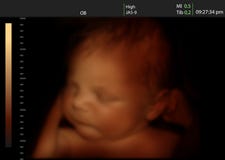 Image of a newborn baby like 3D ultrasound