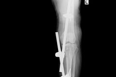 Imagem do raio X do pé da fratura com fixação externo do implante imagens de stock Imagem do raio X do pé da fratura com fixação externo do implante imagens de stock