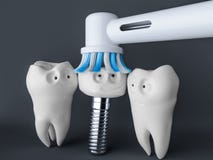Implant- van het tand het menselijke beeldverhaal 3D Teruggeven vector illustratie Implant- van het tand het menselijke beeldverhaal 3D Teruggeven vector illustratie